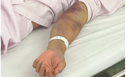 Dịch sốt xuất huyết phức tạp, mỗi ng&agrave;y h&agrave;ng chục ca trở nặng phải nhập viện