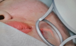 Bộ Y tế: Chấn chỉnh hoạt động kh&aacute;m, chữa bệnh li&ecirc;n quan đến tạo h&igrave;nh thẩm mỹ