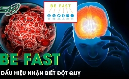 Dấu hiệu nhận biết bệnh nh&acirc;n đột quỵ BE FAST