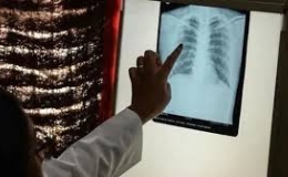 WHO: Lao trở lại l&agrave; căn bệnh truyền nhiễm g&acirc;y tử vong h&agrave;ng đầu