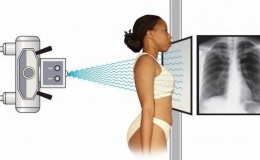 Nghi&ecirc;n cứu đầu ti&ecirc;n tr&ecirc;n thế giới về ứng dụng AI trong chụp X-quang ngực