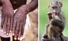 Việt Nam đ&atilde; c&oacute; 56 ca bệnh đậu m&ugrave;a khỉ