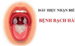 Triệu chứng của bệnh bạch hầu
