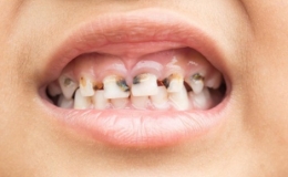 Dấu hiệu cảnh b&aacute;o cơ thể thiếu canxi