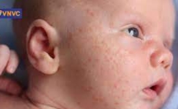 T&igrave;m hiểu th&ocirc;ng tin về bệnh sởi từ c&aacute;c nguồn đ&aacute;ng tin cậy