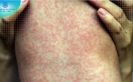 Triệu chứng của bệnh sởi