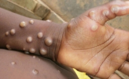 WHO duy tr&igrave; t&igrave;nh trạng khẩn cấp y tế to&agrave;n cầu đối với bệnh đậu m&ugrave;a khỉ
