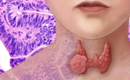 Cảnh b&aacute;o nguy cơ ung thư tr&ecirc;n thế giới