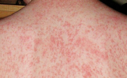 Từ ca tử vong người lớn do sởi, Bộ Y tế khuyến c&aacute;o ph&ograve;ng bệnh đối với nh&oacute;m c&oacute; nguy cơ cao