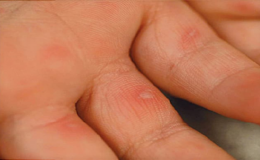 Bệnh tay ch&acirc;n miệng: Nguy&ecirc;n nh&acirc;n, triệu chứng v&agrave; c&aacute;c biện ph&aacute;p ph&ograve;ng ngừa