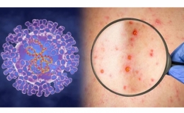  Tăng cường gi&aacute;m s&aacute;t ph&ograve;ng, chống bệnh đậu m&ugrave;a khỉ