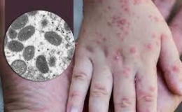 WHO: Bệnh đậu m&ugrave;a khỉ kh&ocirc;ng c&ograve;n l&agrave; t&igrave;nh trạng khẩn cấp y tế to&agrave;n cầu