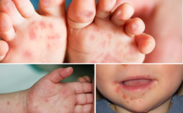Ph&acirc;n biệt lo&eacute;t miệng với bệnh tay ch&acirc;n miệng, lưu &yacute; khi chăm s&oacute;c trẻ tại nh&agrave;