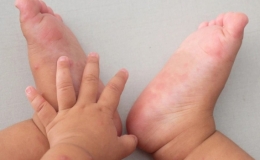 Đảm bảo cung ứng thuốc điều trị bệnh tay ch&acirc;n miệng