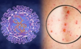 Bộ Y tế khuyến c&aacute;o ph&ograve;ng chống dịch đậu m&ugrave;a khỉ