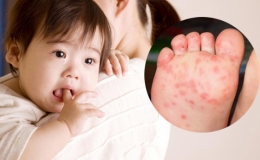 Nguy&ecirc;n nh&acirc;n v&agrave; dấu hiệu nhận biết t&igrave;nh trạng bệnh tay ch&acirc;n miệng ở trẻ