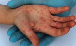 Bộ Y tế th&agrave;nh lập đo&agrave;n kiểm tra, gi&aacute;m s&aacute;t dịch tay ch&acirc;n miệng