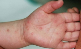 Đ&atilde; c&oacute; nguồn cung thuốc điều trị bệnh tay ch&acirc;n miệng về Việt Nam