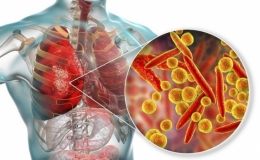 Gia tăng trẻ gặp biến chứng vi&ecirc;m phổi do vi khuẩn mycoplasma pneumoniae