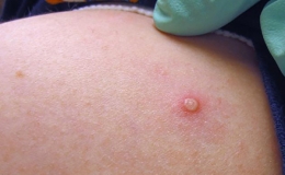 Bộ Y tế hướng dẫn ph&ograve;ng ngừa l&acirc;y nhiễm bệnh đậu m&ugrave;a khỉ tại cơ sở kh&aacute;m, chữa bệnh