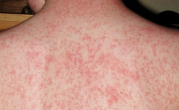 C&aacute;c triệu chứng của bệnh sởi