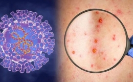 WHO giải đ&aacute;p những c&acirc;u hỏi đ&aacute;ng quan t&acirc;m về bệnh đậu m&ugrave;a khỉ