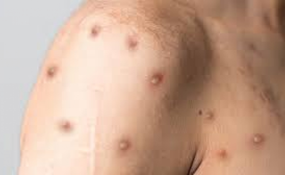 WHO cân nhắc ban bố tình trạng khẩn cấp đối với bệnh đậu mùa khỉ