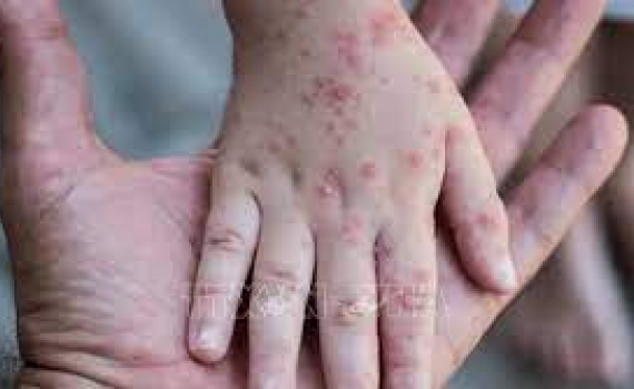 WHO tuyên bố tình trạng khẩn cấp toàn cầu về bệnh đậu mùa khỉ